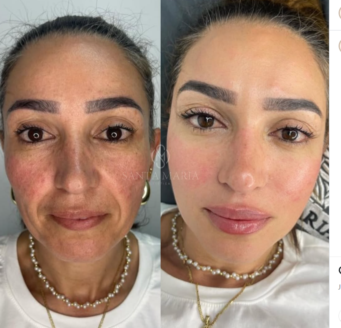 Full Face Sculptra results — collagen stimulation for facial rejuvenation, lifting, and volume restoration.